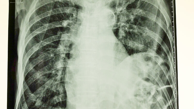 Chest Xray