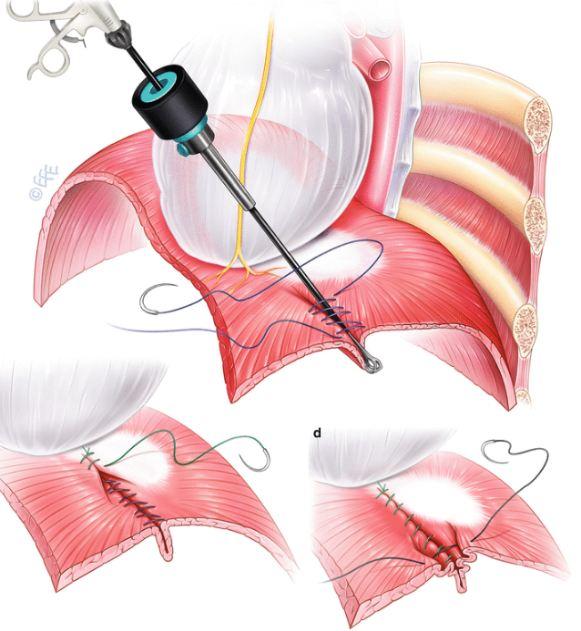 Ptychose Diaphragmatos