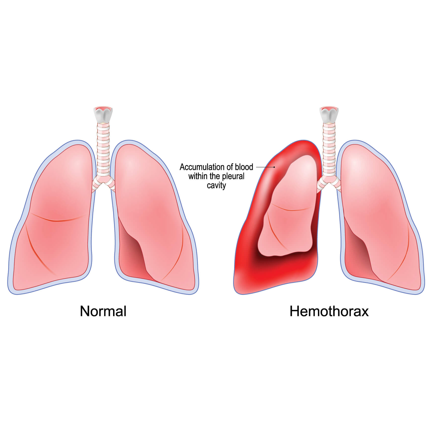 aimothorakas