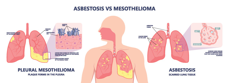 kakoithes mesothilioma ipezokota