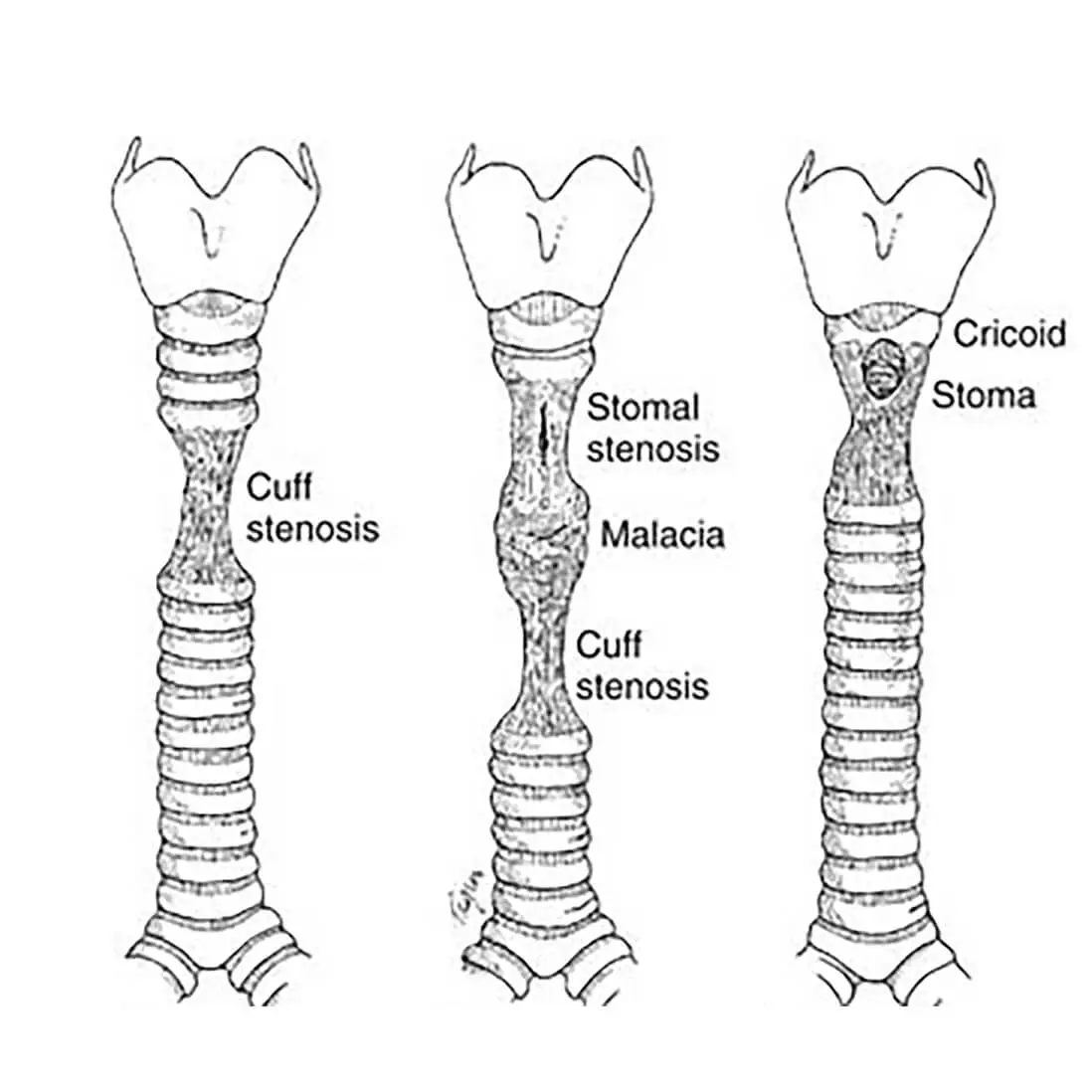kaloithis-stenoseis-traxias