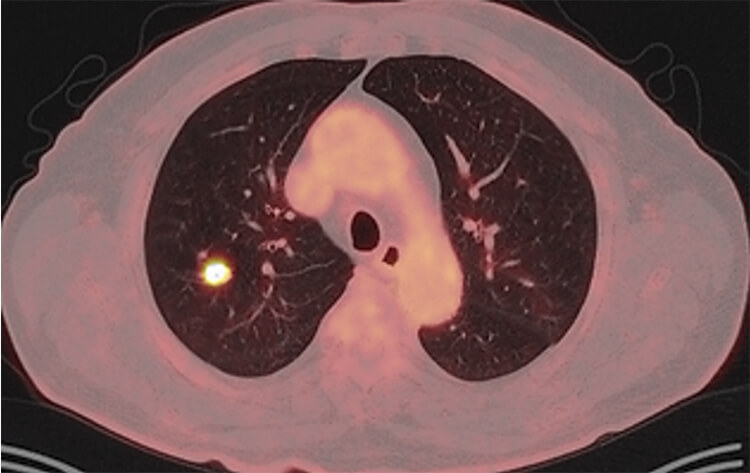 Μονήρης πνευμονικός όζος στο PET CT