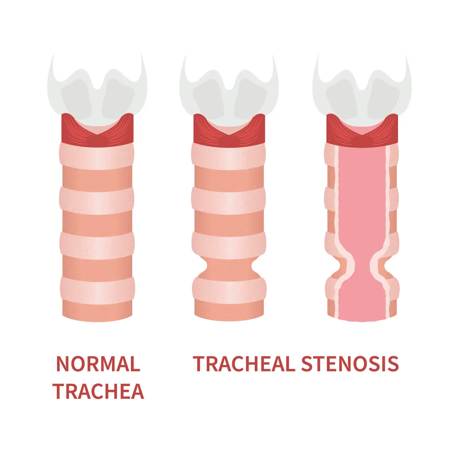 kaloithis-stenoseis-traxias